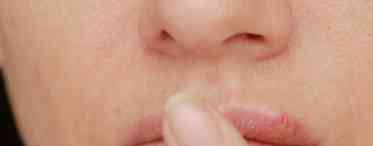 Постійний герпес на губах: ефективно боремося з недугою