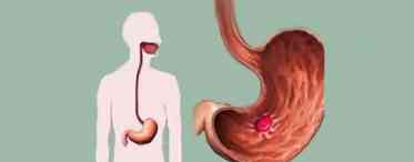 Чим лікується підвищена кислотність шлунка?