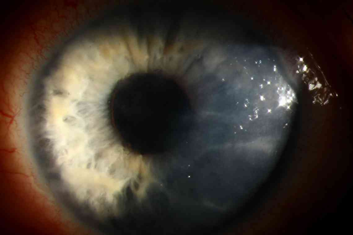 Герпетичний кератит ока