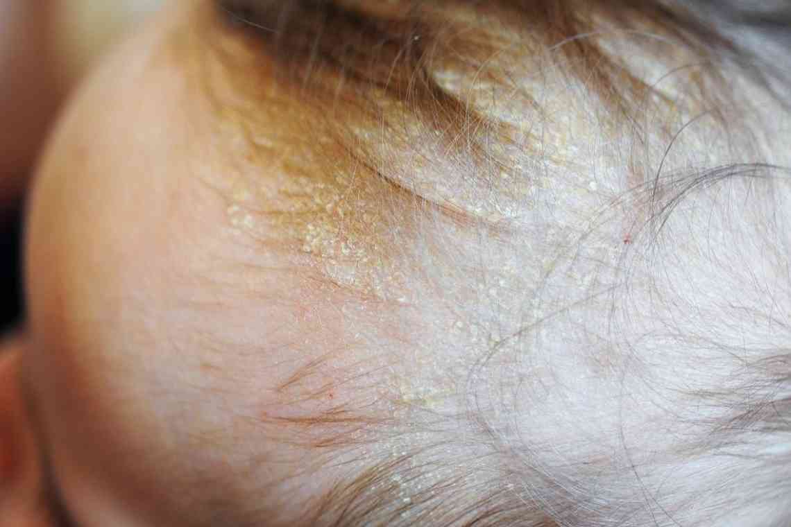 Як вилікувати грибок шкіри голови?