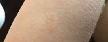 Шершава шкіра у дитини - норма чи відхилення?