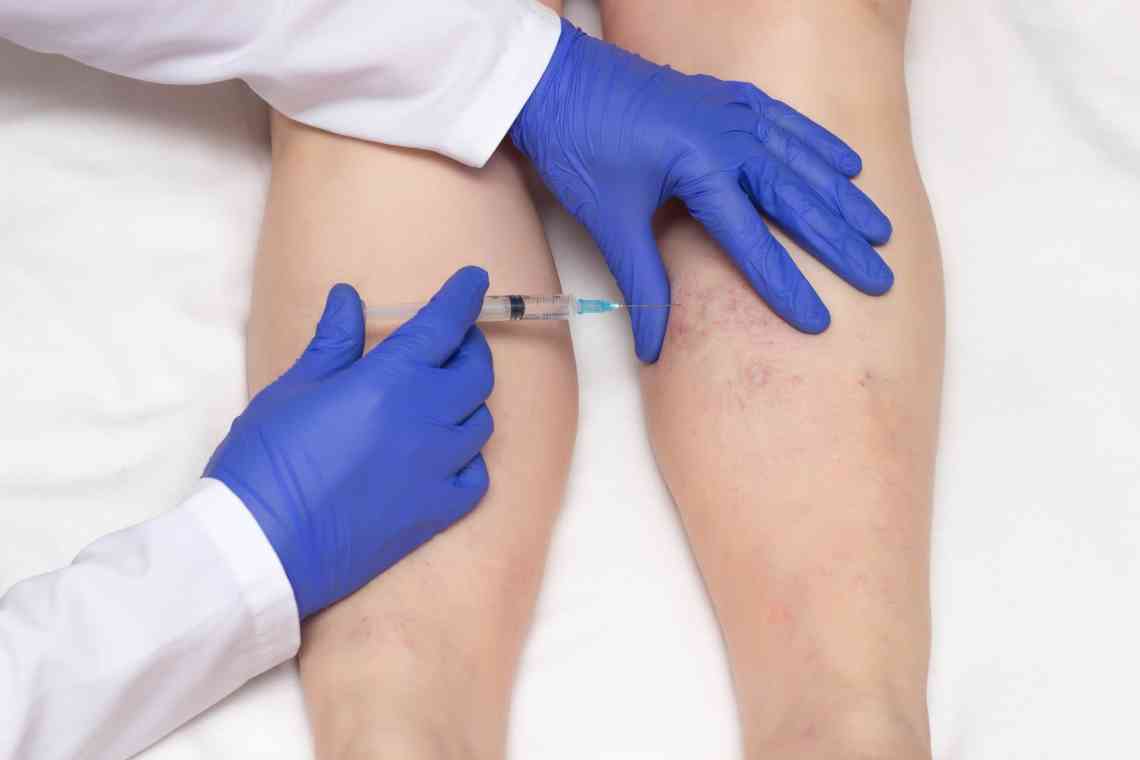 Як позбутися венозної сітки на ногах: народне і традиційне лікування