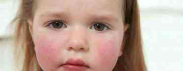 Шершава шкіра у дитини: симптоми і лікування