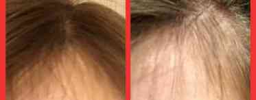 Зміцнення коренів волосся від випадання