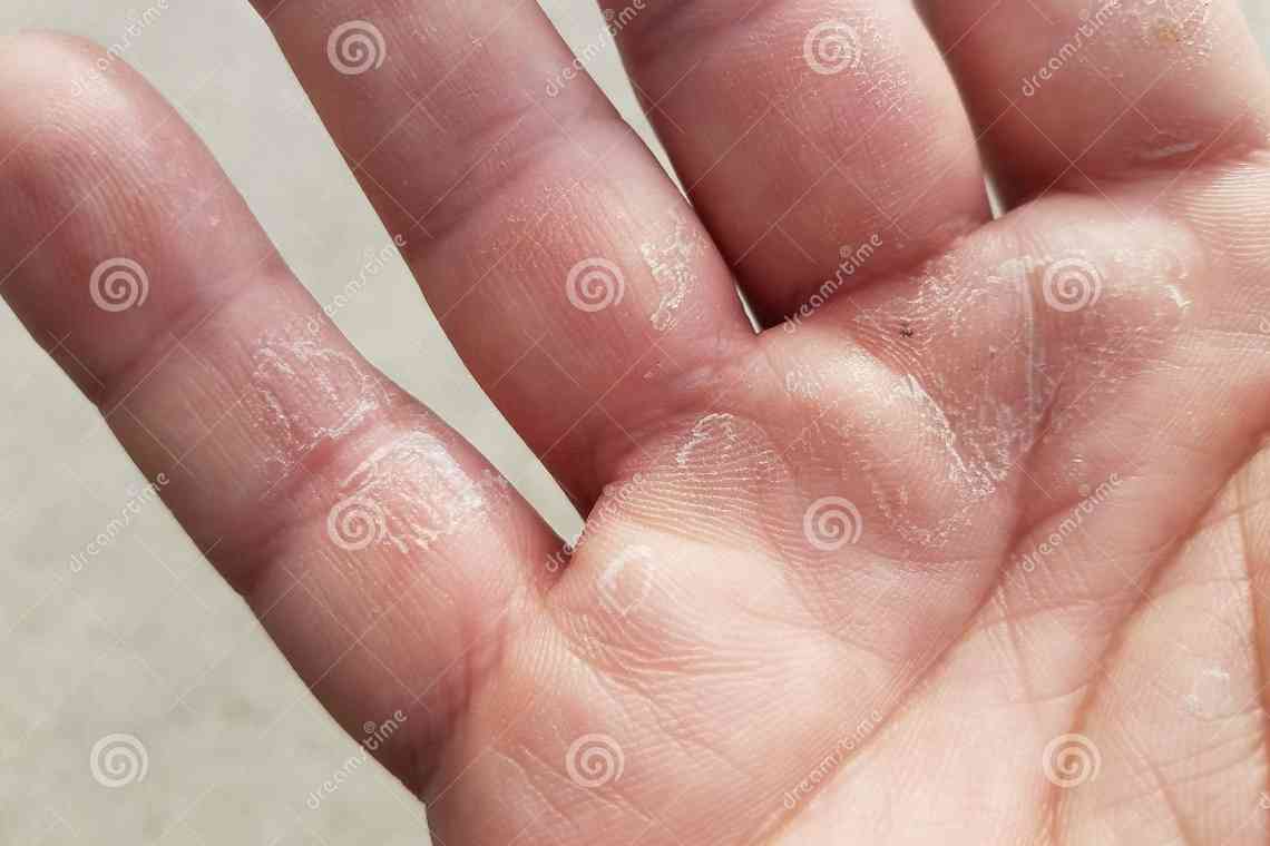 Шелушення пальців рук