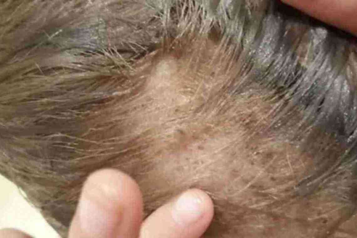 Що провокує появу перхоті і випадання волосся?
