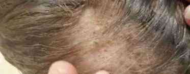 Що провокує появу перхоті і випадання волосся?