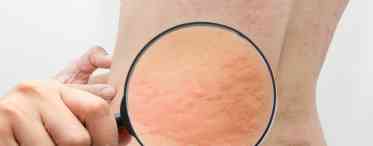 Якими медикаментами лікується шкірний свербіж