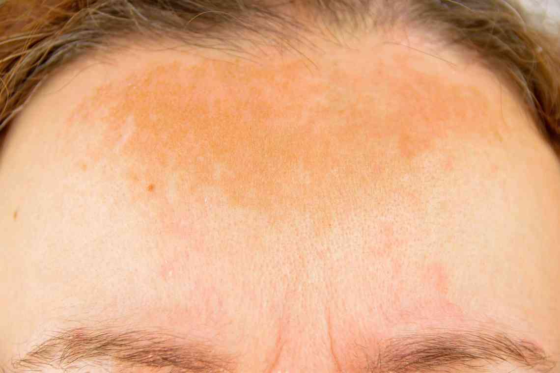 Чому з'являються плями на шкірі грудей і як від них позбутися?