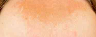 Чому з'являються плями на шкірі грудей і як від них позбутися?