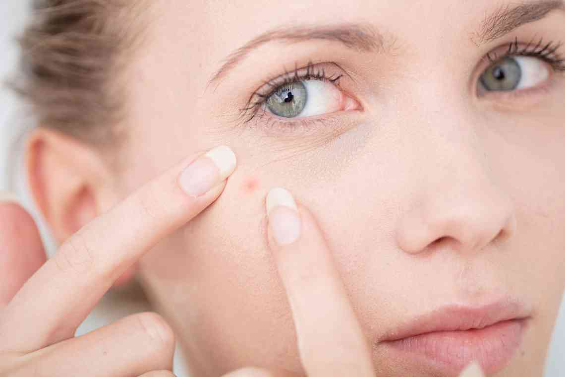 Які таблетки допоможуть позбутися прищів на обличчі?