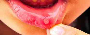 Стоматит на губі: причини та лікування
