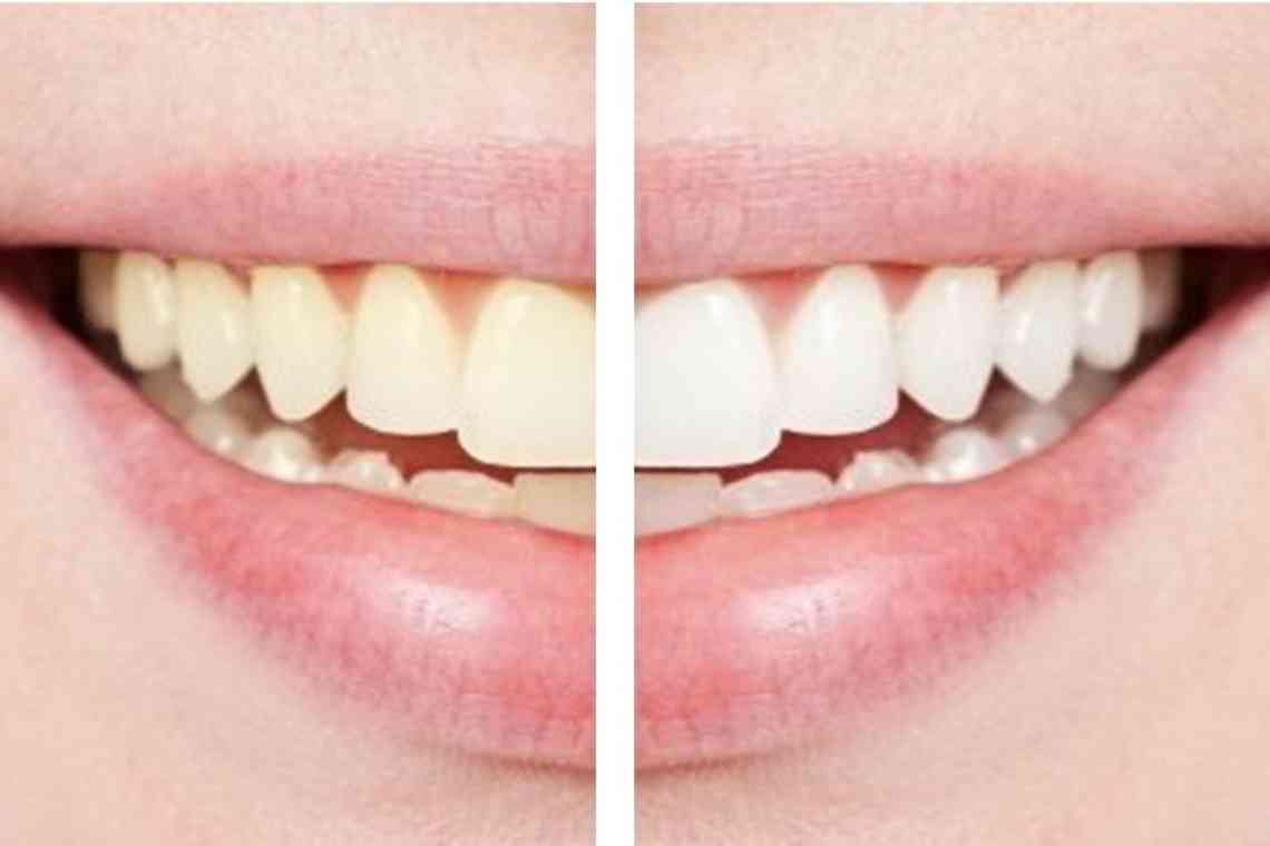 Як відновити емаль зубів? Що можна зробити самостійно в домашніх умовах