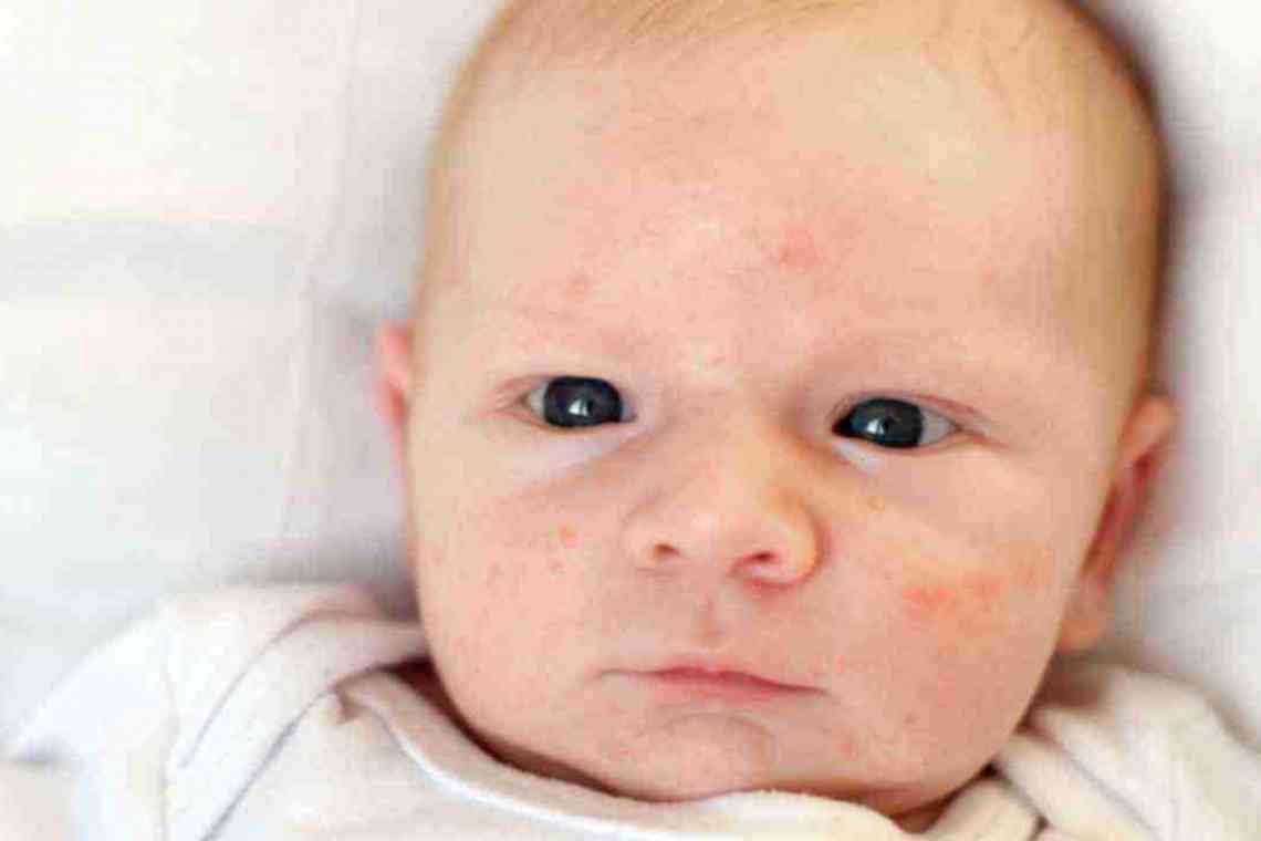 Як прибрати прищі на обличчі у новонародженого?