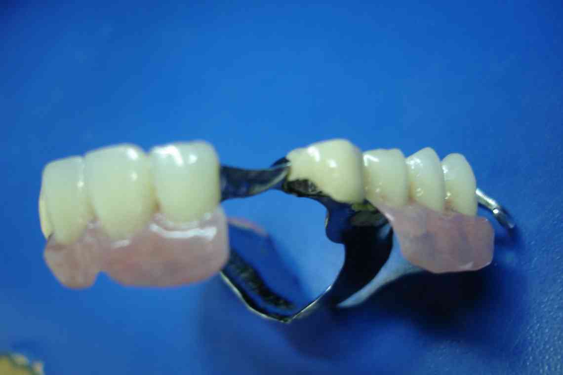 Якими бувають зубні протези і чим вони між собою відрізняються