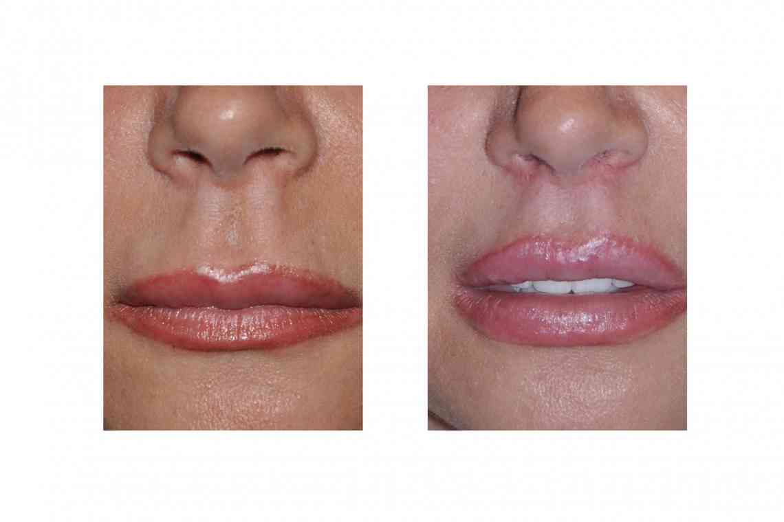 Розрив вуздечки: лікування патології верхньої і нижньої губи