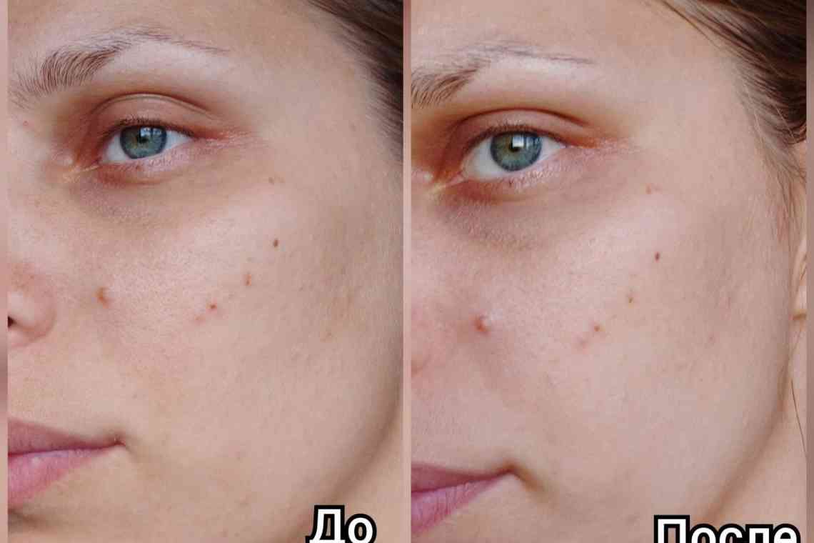 Як видалити шрами на обличчі за допомогою мазі?