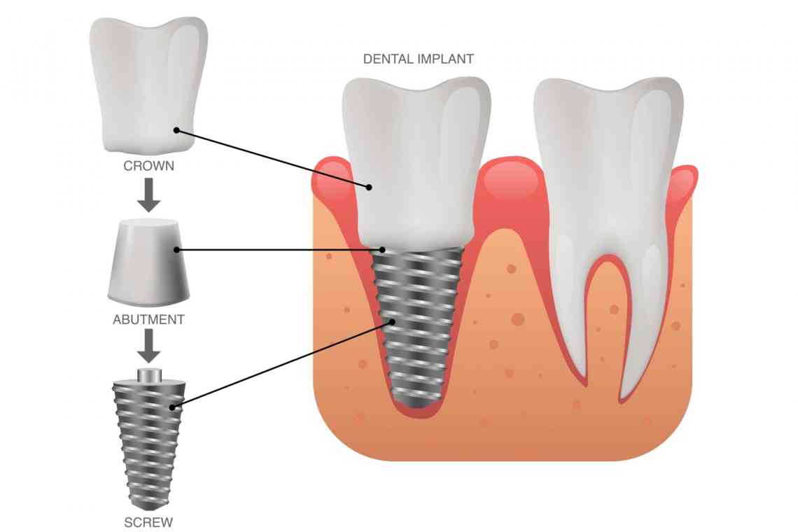 Зубні імплантанти - вибираємо відповідний варіант