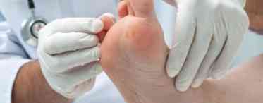 Мозоль на пальці ноги: вилучення та профілактичні заходи