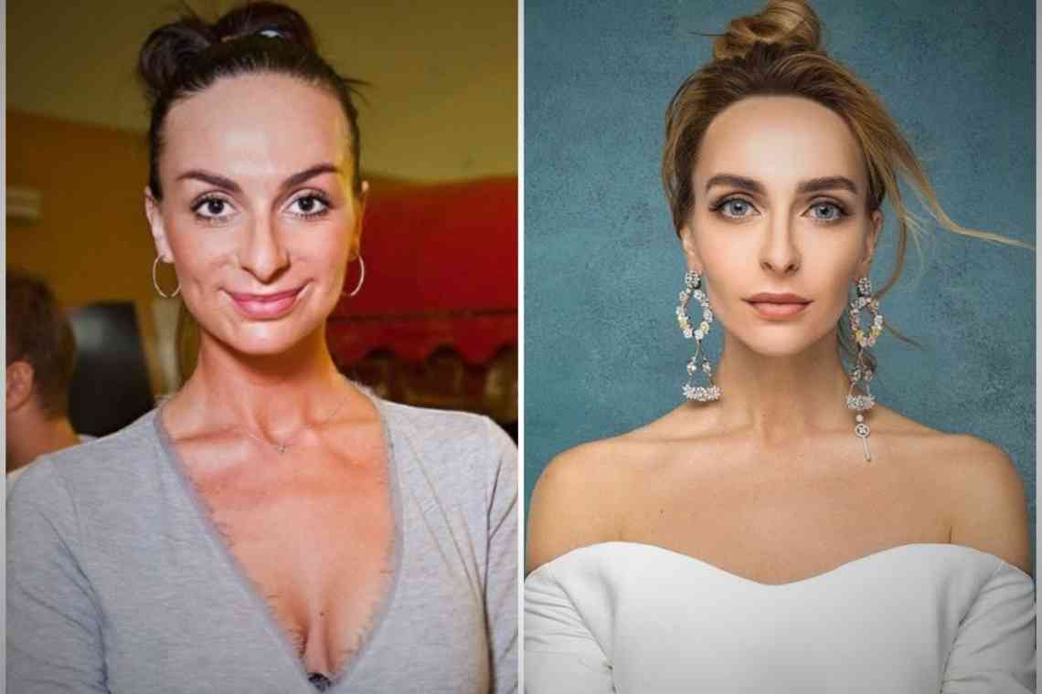 Навіщо Вікторія Берникова збільшила груди і зробила ринопластику? Фото до і після операції.