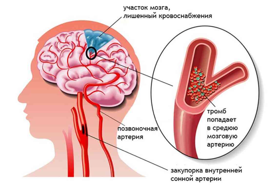 10 способів уникнути інсульту