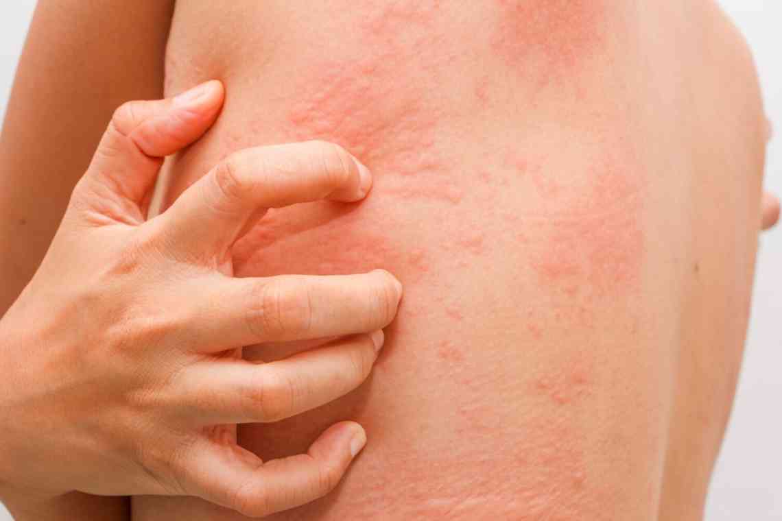Біль у животі, висип і нежить: як проявляється алергія на глютен
