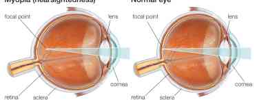 Розфокусування зору: причини, симптоми, лікування