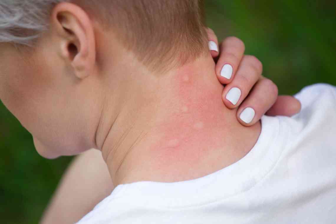 Болить, чешеться, червоніє: як позбутися зуду після укусу комара швидко