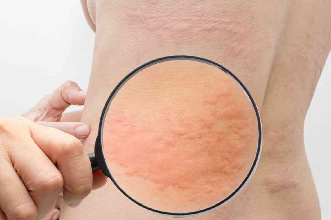 Алергія на пилок: симптоми, лікування та профілактика