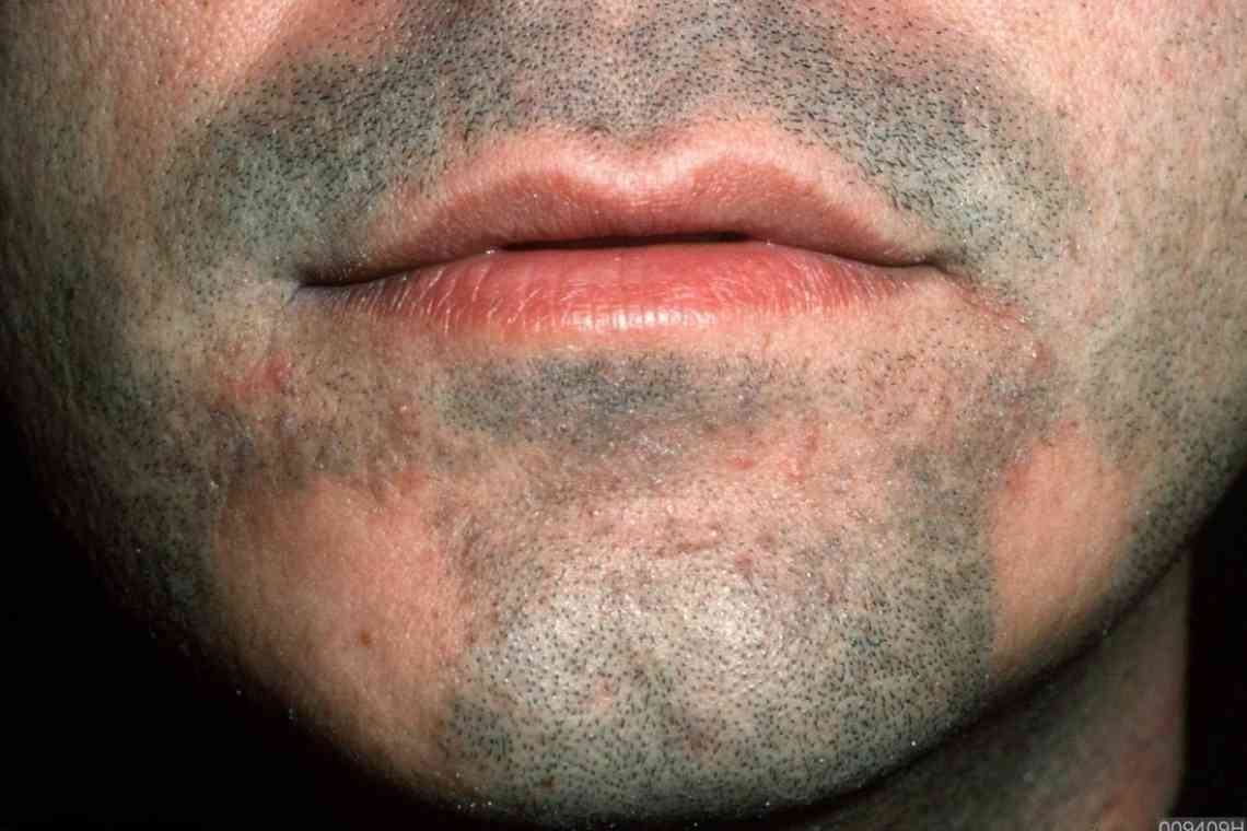 Бородавчастий туберкульоз шкіри