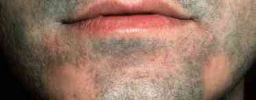 Бородавчастий туберкульоз шкіри