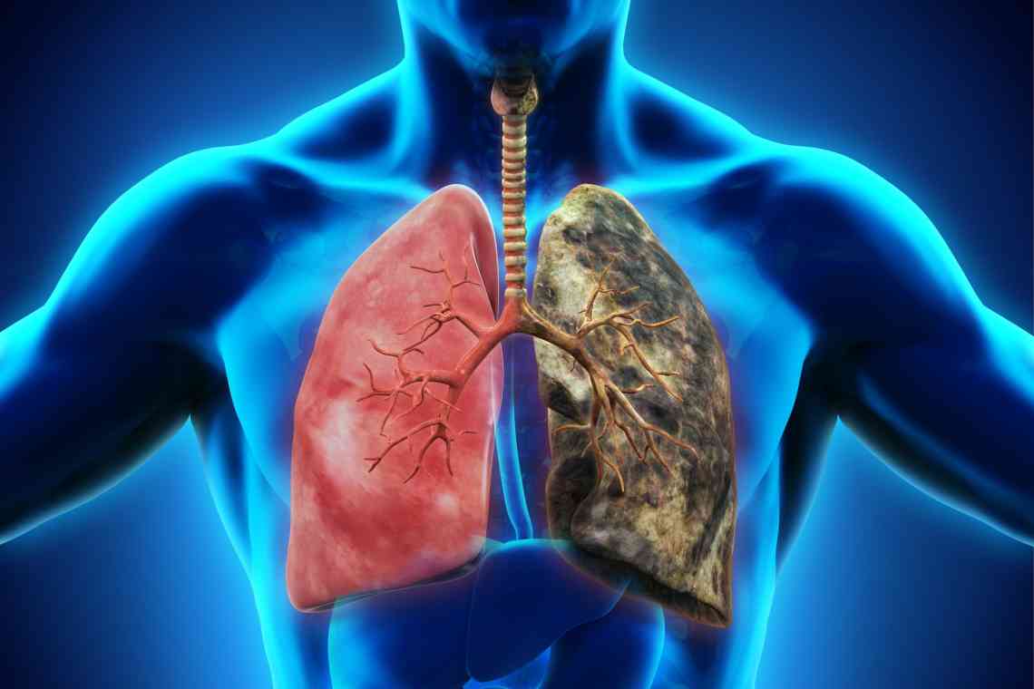 Цирротичний туберкульоз легенів