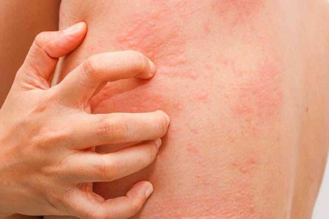Алергія: що це таке, чому виникає і як з нею боротися