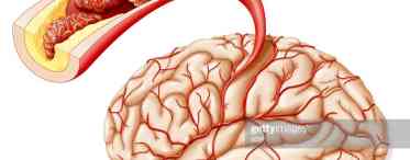 Атеросклероз судин головного мозку (Церебральний атеросклероз)