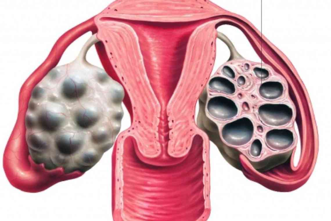 Запитали у гінеколога: чи можна завагітніти при полікістозі яєчників