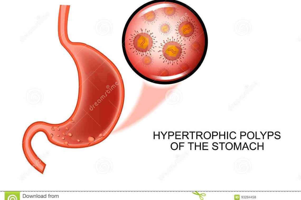 Поліпи шлунка