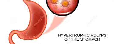 Поліпи шлунка