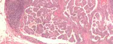 Папілярний рак щитовидної залози