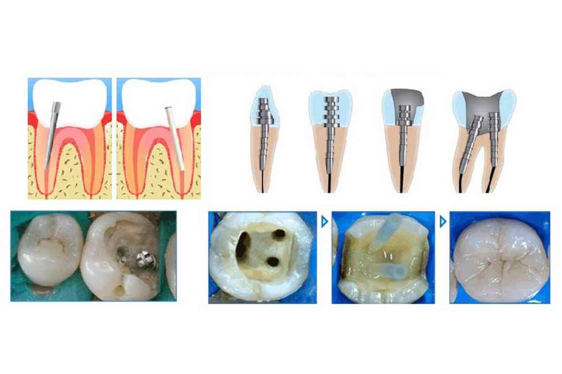 Гіперестезія зубів