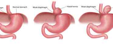 «Грижа стравоходного отвору діафрагми (Грижа стравоходу, Діафрагмальна грижа, Параезофагеальна грижа)»