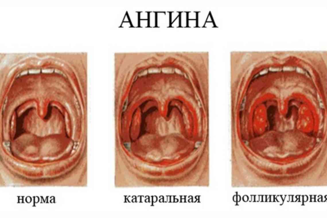 Хронічний стеноз гортані