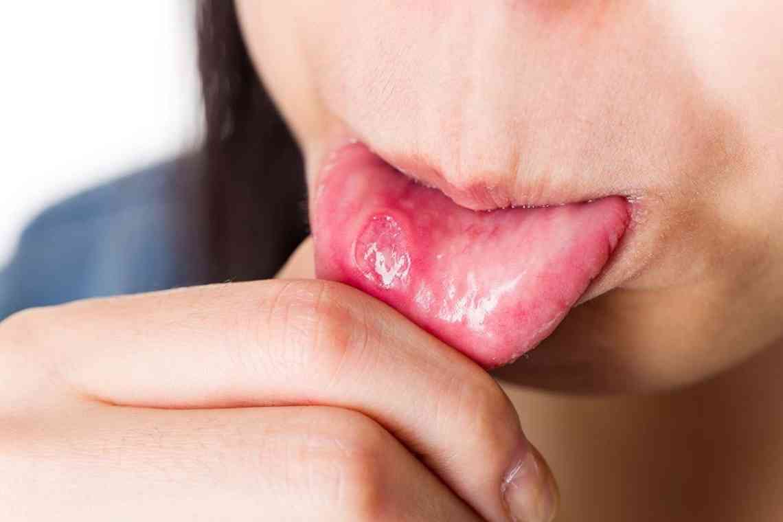 Доброякісні пухлини язика