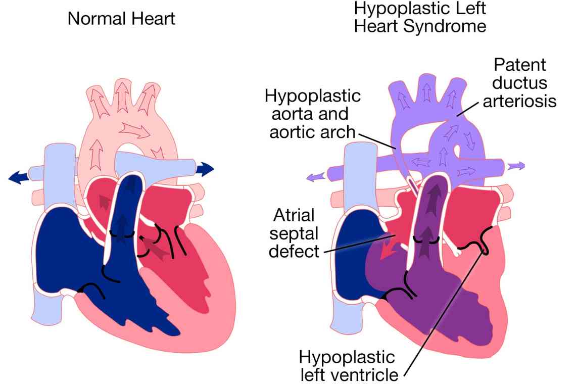 Синдром гіпоплазії лівих відділів серця