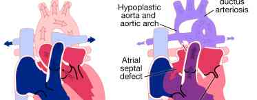 Синдром гіпоплазії лівих відділів серця