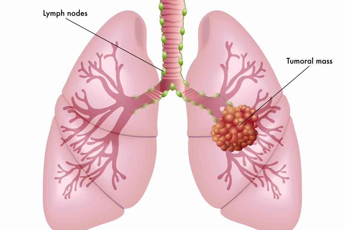 Центральний рак легені