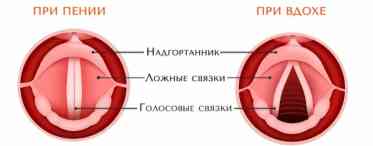 Гострий стеноз гортані