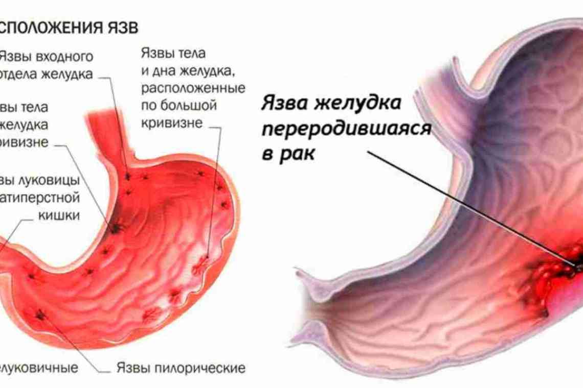 Виразка шлунка (Виразкова хвороба шлунка)