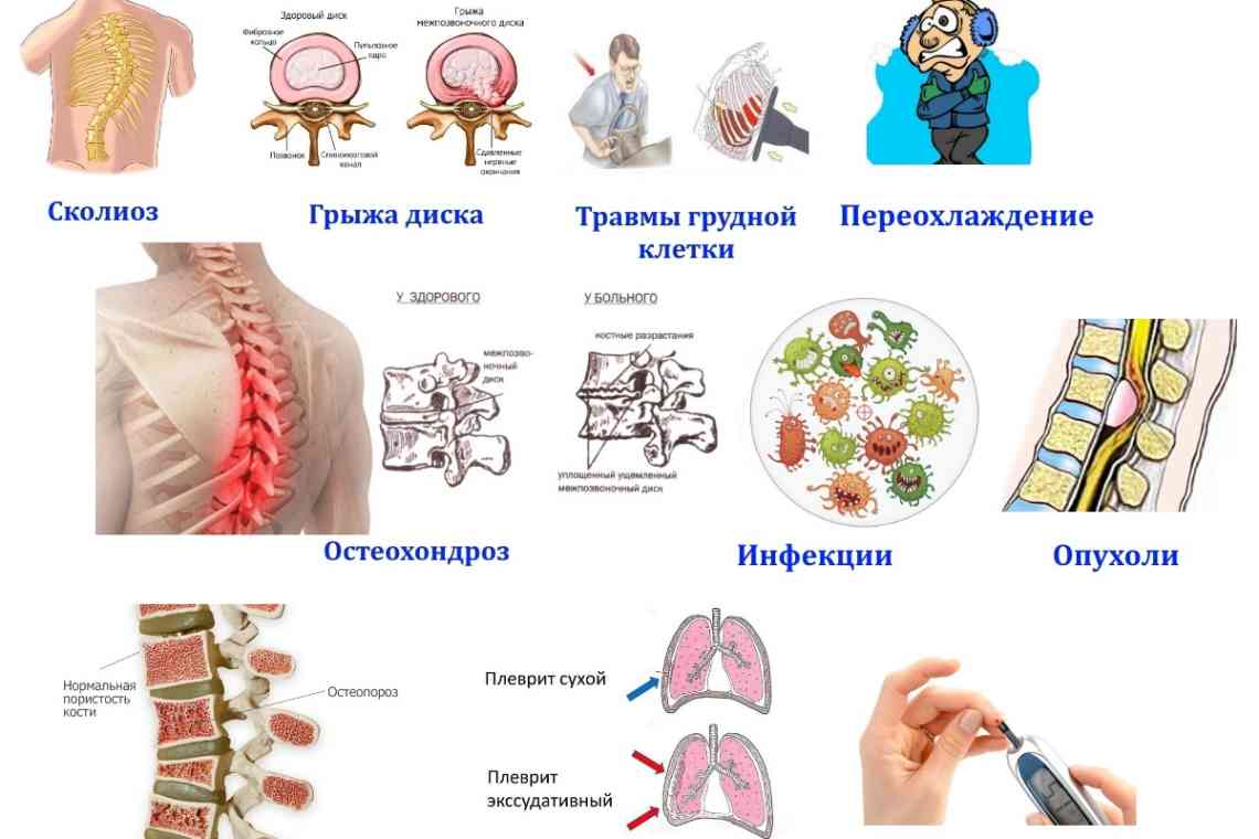 Міжреберна невралгія