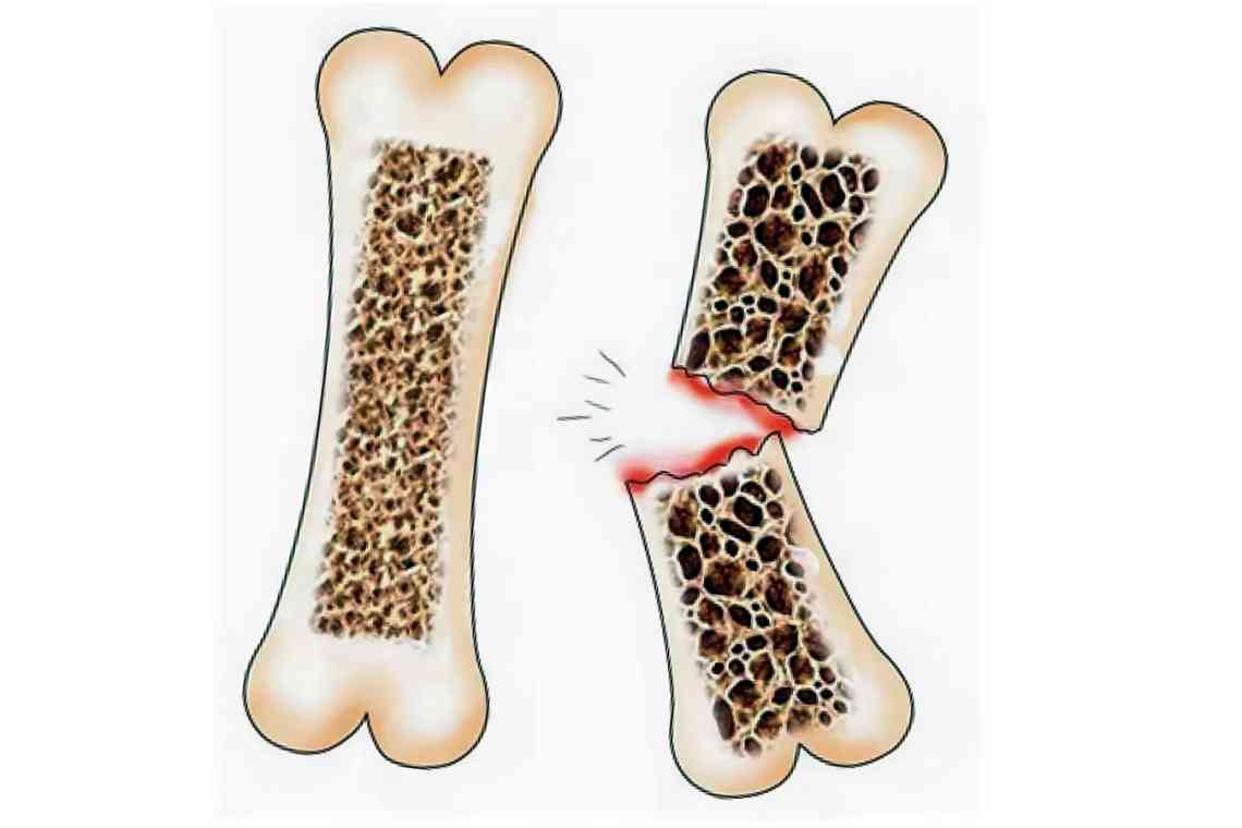 Ювенільний остеопороз (Юнацький остеопороз)