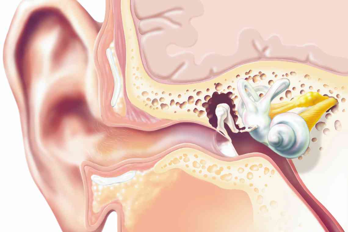 Екзостози зовнішнього слухового проходу
